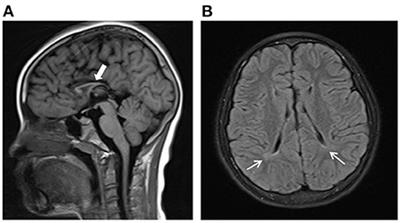 Case report: Novel compound heterozygous missense mutations in the DDHD2 gene in a Chinese patient associated with spastic paraplegia type 54